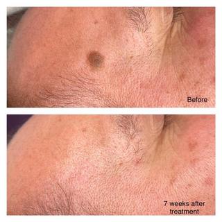 Seborrhoeic Keratosis removal before and after.JPG