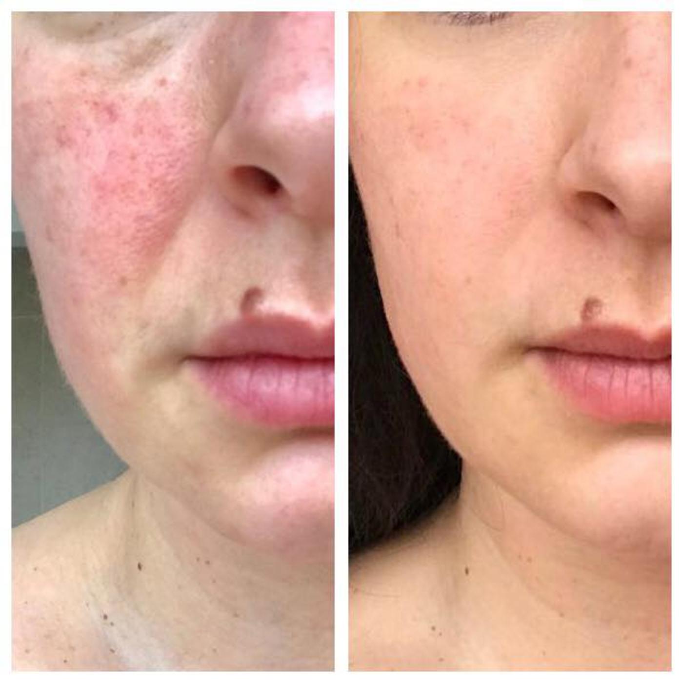 BEFORE & AFTER FOLLOWING NIMUE HOMECARE & IN SALON TREATMENTS FOR SENSITIVE SKIN FOR 6 MONTHS