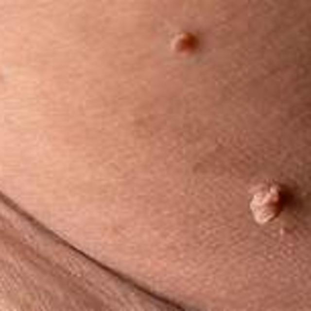 Skin Tags Image 1