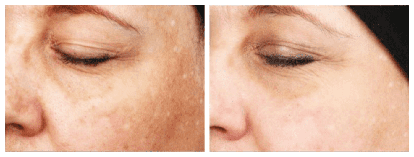 BEFORE & AFTER FOLLOWING NIMUE HOMECARE & IN SALON TREATMENTS FOR HYPERPIGMENTED SKIN FOR 6 MONTHS