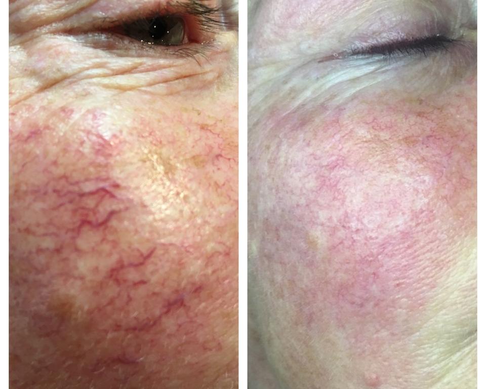 Facial Red Veins Before and After.JPG