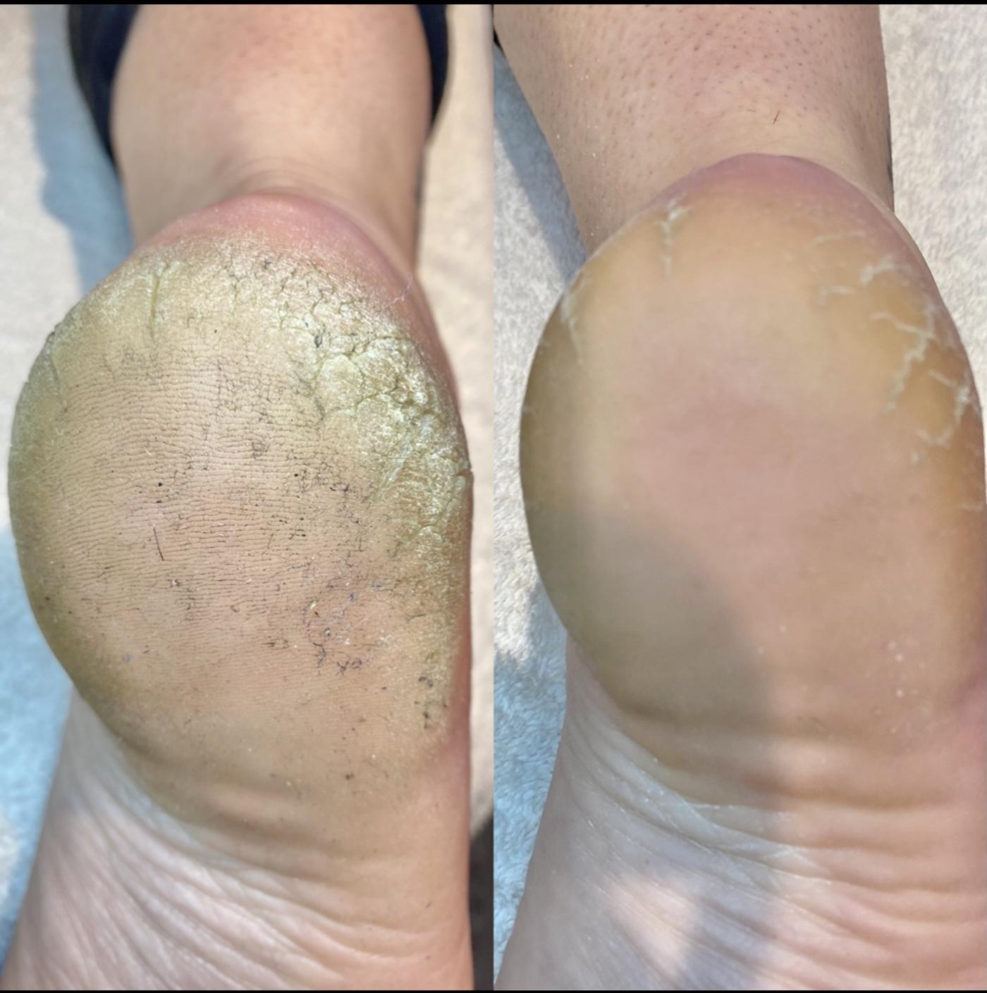 Footlogix before and after